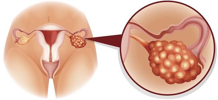 Ce sont les symptômes les plus caractéristiques du cancer de l’ovaire